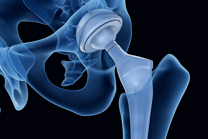 Anterior Approach to Total Hip Replacement