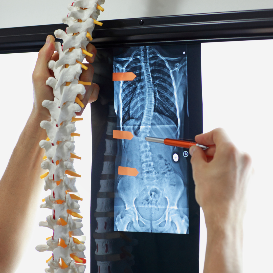 Understanding Scoliosis: Insights from Iowa Ortho